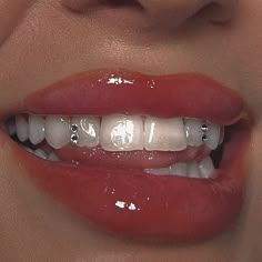 a woman's smile with braces on her teeth and gums all over the mouth