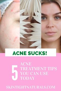 5 Acne treament tips can use today Are you spending most of your life locked in your bedroom miserable about your raging acne? Do you hate looking in the The Dating Divas, Heavy Makeup, Acne Problem, Living The Life, Beauty Hacks Video, Face Care