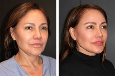 facelift patient before after new york Deep Plane Facelift, Endoscopic Brow Lift, Jaw Reduction Surgery, Brow Lifting, Facelift Surgery, Sagging Cheeks