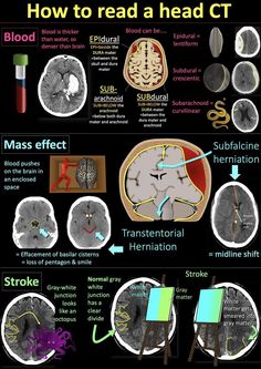 an image of how to read a head ct