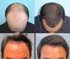 Utah Hair, Hair Transplant Women, Hair Implants, Androgenetic Alopecia, Diy Hair Masks, Fue Hair Transplant, Pattern Baldness