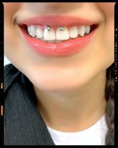 a close up of a person's smile with braces