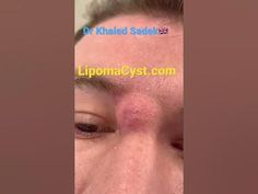 Ear Cysts Popping, Extractions Facial Videos, Cysts Popping Videos, Boil Popping Videos, Hard Pimple, Big Zits, Pimple Popper Videos Black Heads, Blackheads On Face