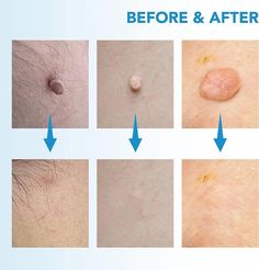 10 Effective Ways to Remove Skin T Red Moles, Wart Remover, Turmeric Vitamins, Back Stretches For Pain