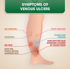 Arterial Vs Venous Ulcers, Varicose Vein Ulcers, Leg Ulcers Remedies, Healthy Veins, Community Nurse, Leg Health, Home Remedies For Spiders, Leg Ulcers