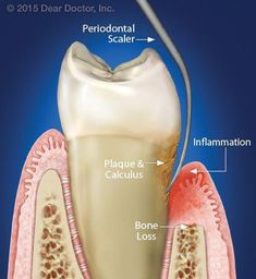 If the natural teeth can be saved, are implants truly a �better� treatment option? And if you want to save your own teeth, what alternative treatments might be needed? Learn the answers inside. Dental Assistant School, Dental Nurse, Dental Photos, Dental Images, Best Mouthwash, Dental Assisting, Dental Exam, Discolored Teeth, Dental Life