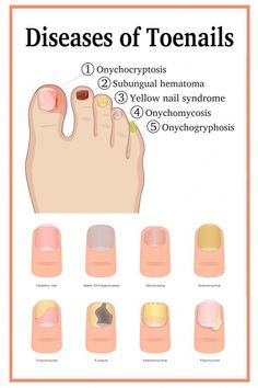 Nail Health Problems, Nail Health Signs, Medical Pedicure, Pale Nails, Natural Antifungal, Nail Problems, No Chip Nails, Nail Fungus Remedy, Health Signs