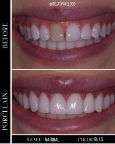 Beautiful Teeth Smile Pictures, Natural Looking Veneers Teeth, Big Teeth Smile, Smile Types, Teeth Makeover, Natural Veneers, Perfect Smile Teeth, Smile Transformation