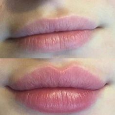 Needleless Lip Filler, Korean Lip Filler Before And After, Desired Lips, Juvederm Lips, Permanente Make-up