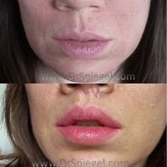 Lip Lift Surgery, Frank Tattoo, Plastic Surgery Korea, Lip Surgery, Lip Lift, Facial Bones, Facial Surgery, Lip Blush, Tattoo Clothing