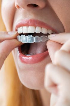 Perfect Smile Teeth, Diy Teeth, Teeth Alignment, Traditional Braces, Remedies For Tooth Ache, Healthy Teeth And Gums, Healthy Gums, Diy Teething, Loose Tooth