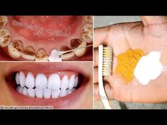 Hemmelige tandlæger vil ikke have, at du skal vide det: blege tænder på kun 2 minutter - YouTube Baking Soda Teeth, Natural Teeth Whitening Diy, Natural Teeth Whitening Remedies, Baking Soda Teeth Whitening, Teeth Whitening Homemade, Black Teeth, Teeth Whitening Remedies, Teeth Whitening Diy, Teeth Health