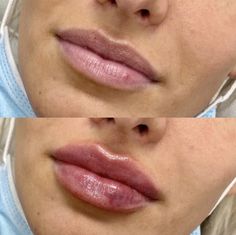 Lip filler before and after photo Lip Filler Smile Before And After, 1ml Lip Filler Shapes, Lip Filler Before And After 1ml Juvederm, Lip Filler Before And After Juvederm, Lips Before And After Injections, 1ml Lip Filler Before And After, Juvederm Before And After Lips, 0.5 Lip Filler Before And After, Half Syringe Lip Filler Before And After