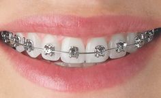 Different Types Of Braces, Ceramic Braces, Braces Cost, Types Of Braces, Invisalign Aligners