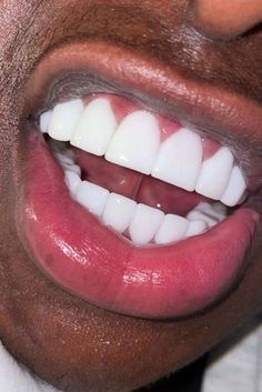 "how to get white teeth fast as a man"Picture this: you’ve put on your best suit, used perfume, prepared your interview notes well, and done all that you cou... Perfect White Teeth, Loose Teeth, Interview Notes, Teeth Aesthetic, Pretty Teeth, Get Whiter Teeth, Pretty Henna, Veneers Teeth, Beautiful Teeth