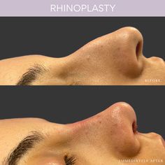 Rhinoplasty Before and After Rhinoplasty Droopy Tip, Nose Rhinoplasty Before After, Button Nose Nose Job, Nose Plastic Surgery Before After, Before And After Plastic Surgeries, Nose Before And After, Dorsal Hump Rhinoplasty, Nose Surgery Before And After, Nose Tip Surgery Before After