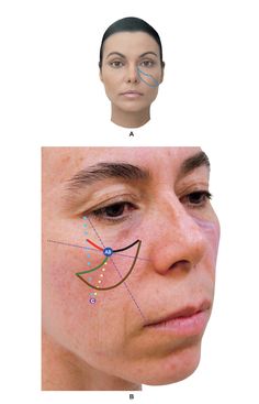 Chapter 10 Filler Injection of the Malar and Zygomatic Regions | Plastic Surgery Key Injection Snap, Botox Injection Points, Zygomatic Bone, Skin Booster Injection, Facial Anatomy For Injectors, Filler Injection, Facial Veins, Attractive Face, Cheek Fat