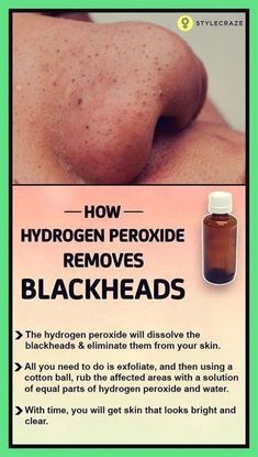 Black Heads, Get Rid Of Blackheads, Hydrogen Peroxide, Natural Home Remedies, Health And Beauty Tips, Skin Tips, Blackhead Remover, The Skin, Face Care