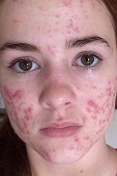 Acutane Before After, Spironolactone Before And After, Acne Aesthetic, Acne Pictures, Back Acne Remedies, Blind Pimple