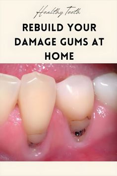 Doctors were shocked when they saw this… Gum Repair, Whitening Teeth, Natural Teeth Whitening