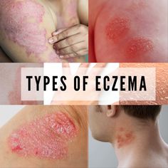 7 TYPES OF ECZEMA AND ITS SYMPTOMS Spring Allergies, Futuristic Gadgets, Soap Recipe, Skin Condition, Gadgets Technology, Beauty Natural