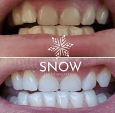 Snow Teeth Whitening, Teeth Whitening Homemade, Get Whiter Teeth, Teeth Whitening Remedies, Laser Teeth Whitening, Teeth Whitening System, Teeth Implants, Yellow Teeth, Tooth Sensitivity