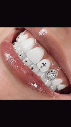 Teeth Whitening, Lips, Gems