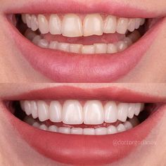 Cute Teeth, Dental Mouthguards, Tooth Whitening, Grills Teeth