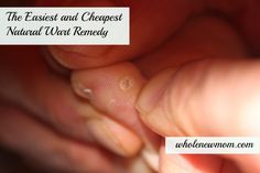 Natural Wart Remover, Natural Wart Remedies, Diy Skin Care Recipes, Staying Healthy, Holistic Nutrition, Skin Care Recipes, Diy Skin Care