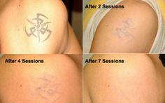 four pictures showing different stages of laser tattoo removal on the back of a woman's shoulder