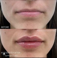 Lip Fillers Juvederm, Permanente Make-up, Facial Aesthetics, Lip Filler