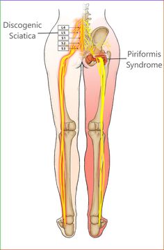 Relieve nerve root compression like radiculopathy and sciatica by spinal decompression therapy