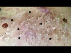 Relaxing Everyday With Loan Nguyen Skincare - YouTube How To Prevent Blackheads, Ear Pimple, Clear Skin Routine, Clear Blackheads, Blackhead Extraction, Most Satisfying Video, Charcoal Mask, Clear Complexion, Most Satisfying