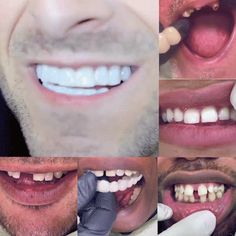 Misaligned Teeth, Chipped Tooth, Bad Teeth, Dentist Visit, Gap Teeth, Teeth Braces, Missing Teeth