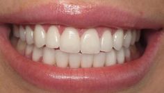 Crush Signs, Teeth Aesthetic, Pretty Teeth, Beautiful Teeth, Wish Board, Porcelain Veneers, Perfect Teeth, Smile Teeth