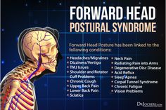 the head and neck are highlighted in this medical poster with caption for forward head postural syndrome