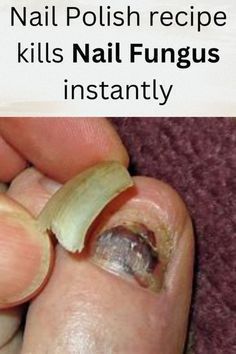 If you suffer with any type of fungus infection…. “REAL cause of Toenail fungus revealed and How to Eliminate it in less than 14 Days” Toenail Health, Nail Remedies, Polish Recipe, Toenail Fungus Remedies, Nail Fungus Remedy, Regular Nail Polish, Nail Infection, Fungal Nail, Toenail Fungus