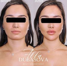 Chin Fillers Before After Round Face, Facial Contouring Fillers, Cheekbone Filler, Face Contouring Fillers, Masseter Botox Before And After, Eye Lift Surgery, Facial Before And After, Nose Surgery Rhinoplasty