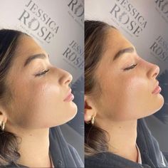 Perfect Nose Profile, Button Nose Filler, Cute Noses Woman, Nose Ideas For Nose Job, Small Nose Rhinoplasty, Nose Job Ideas, Small Nose Job, Noses For Nose Jobs, Nose Job Nose