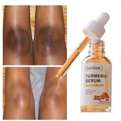 Pigmentation remover, dark spots remover,  skin care , turmeric serum, turmeric Face Whitening Serum, Turmeric Serum, Dark Spot Corrector Serum, Dark Spots On Skin, Dark Spot Corrector, Lemon Oil, Skin Glow, Skin Serum