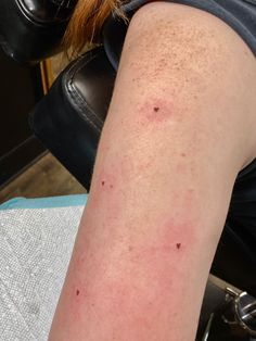 a person with acne on their arm sitting in a chair