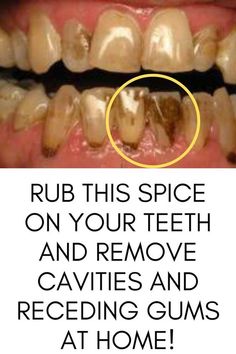 Rub this spice on your Teeth and remove Cavities and receding Gums at home!#toothdecay #toothproblem #WhatAreOralCare #WhatIsOralCare #HowToCareForOralHealth Tooth Cavity, The Teeth, Oral Care Routine