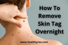 People don't remove skin tags only for cosmetic or aesthetic reasons. If you develop skin tags regularly and on multiple parts of the body, Castor Oil For Skin, Healthy Book, Home Remedies For Skin, Tag Remover, Mole Removal