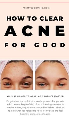 Clear Face Tips, Acne Free Skin, Face Tips, Acne Skincare Routine, Beauty Tips For Glowing Skin, Clear Skin Tips, Healthy Skin Tips, Face Acne, Acne Remedies