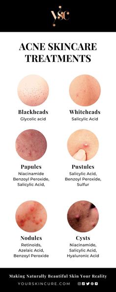 Healthy Skin Care Acne, Facial Exfoliant, Haut Routine, Skin Facts, Skin Care Routine Order, Skin Care Guide, Clear Healthy Skin, Acne Treatments