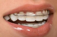 Adult Braces, Traditional Braces, Invisible Braces, Clear Braces