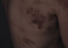 the back of a shirtless man with brown spots on his body and chest area