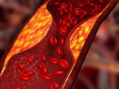 5 Drinks that Help Unclog Arteries Fast! - BlackDoctor.org - Where Wellness & Culture Connect Clear Arteries, Pure Cranberry Juice, Lowering Ldl, Lower Ldl Cholesterol, Coronary Arteries