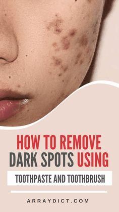 #NaturalRemedies#DarkSpotRemoval#ClearSkin#SkinCareTips#HomeRemedies#GlowingSkin#BeautyHacks#HealthySkin#NaturalBeauty#DIYBeauty#OrganicSkinCare#SkinCareRoutine#SpotlessSkin#NaturalHealing#AntiAging#HerbalRemedies#SkinBrightening#BeautyTips#HolisticHealth#EcoBeauty Brown Spots On Hands, Dark Spots Remedies, Brown Age Spots, Brown Spots On Skin, Dark Spots On Face, Brown Spots Removal, Brown Spots On Face, Dark Spots On Skin, Skin Spots