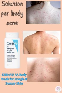 CeraVe SA Body Wash for Rough and Bumpy Skin gently exfoliates and smooths skin texture, helping to clear body acne with salicylic acid and hydrating ceramides. #bodyacne #bodycare #bodycareroutine #bodycareathome #howtocurebodyacne #bodyacnetreatments #bodywash #cerave #ceraveskincare Smooth Skin Body Routine, How To Remove Body Acne, How To Get Rid Of Body Acne Products, Best Body Acne Products, Back Acne Products, Skincare Acne, How To Get Rid Of Back Acne, Body Acne How To Get Rid Of, Body Skin Care Back Acne